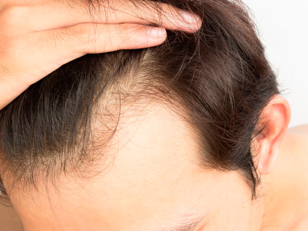 Сандалор – средство от выпадения волос (облысения)