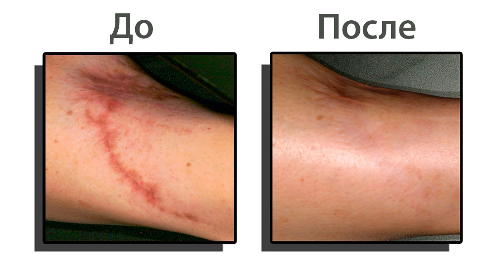 Удаление шрамов и рубцов (до и после)