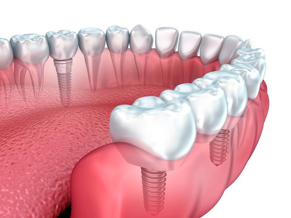 Зубные импланты (имплантаты)